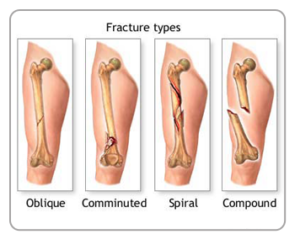 types of fracture